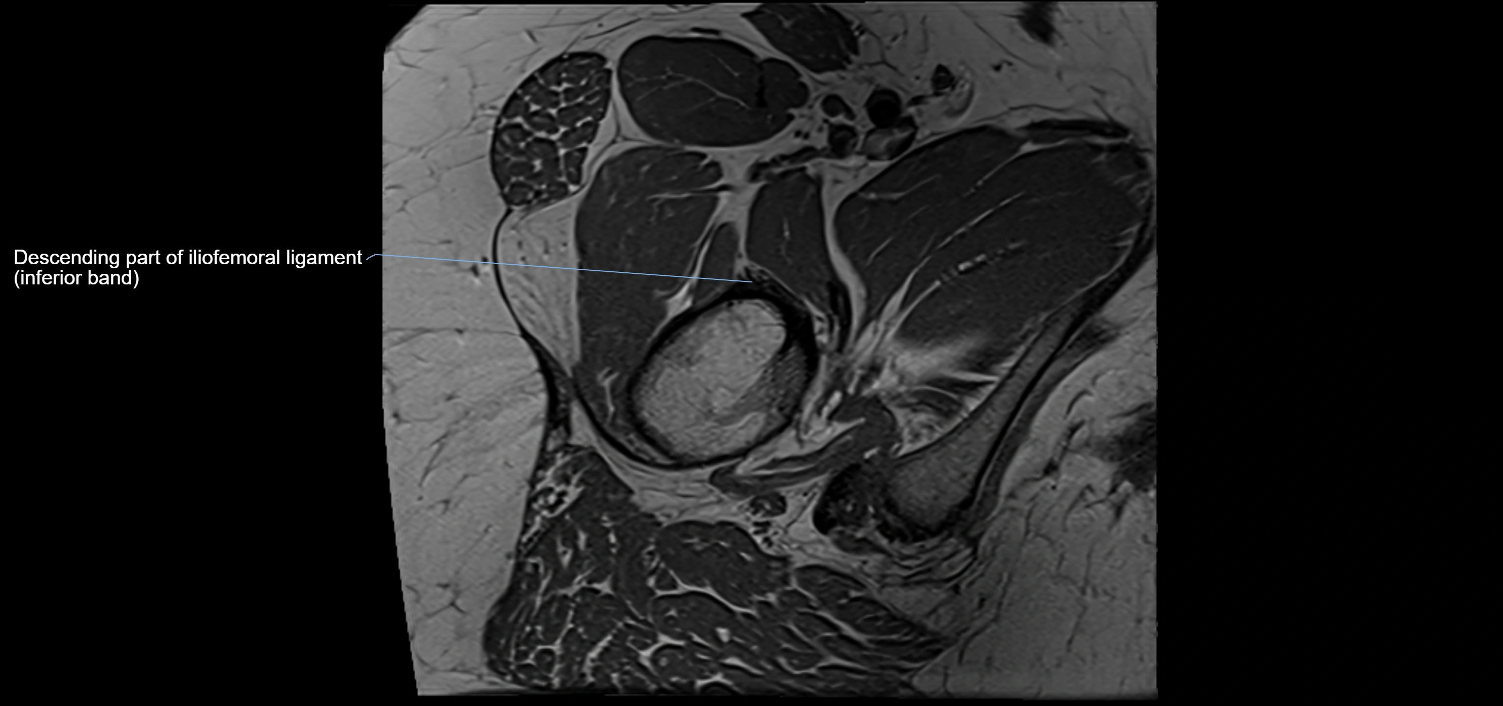 Hip ligament anatomy axial 3T MRI image -img-13001-00029.webp